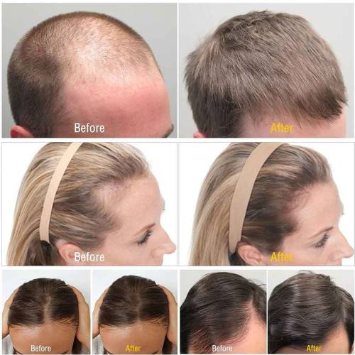 Derma roller Hair regrowth