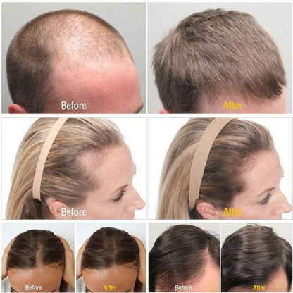 Derma roller Hair regrowth