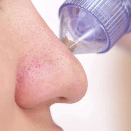 4-in-1 Blackhead Extractor